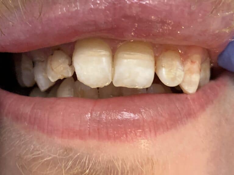 ba_whitening_after