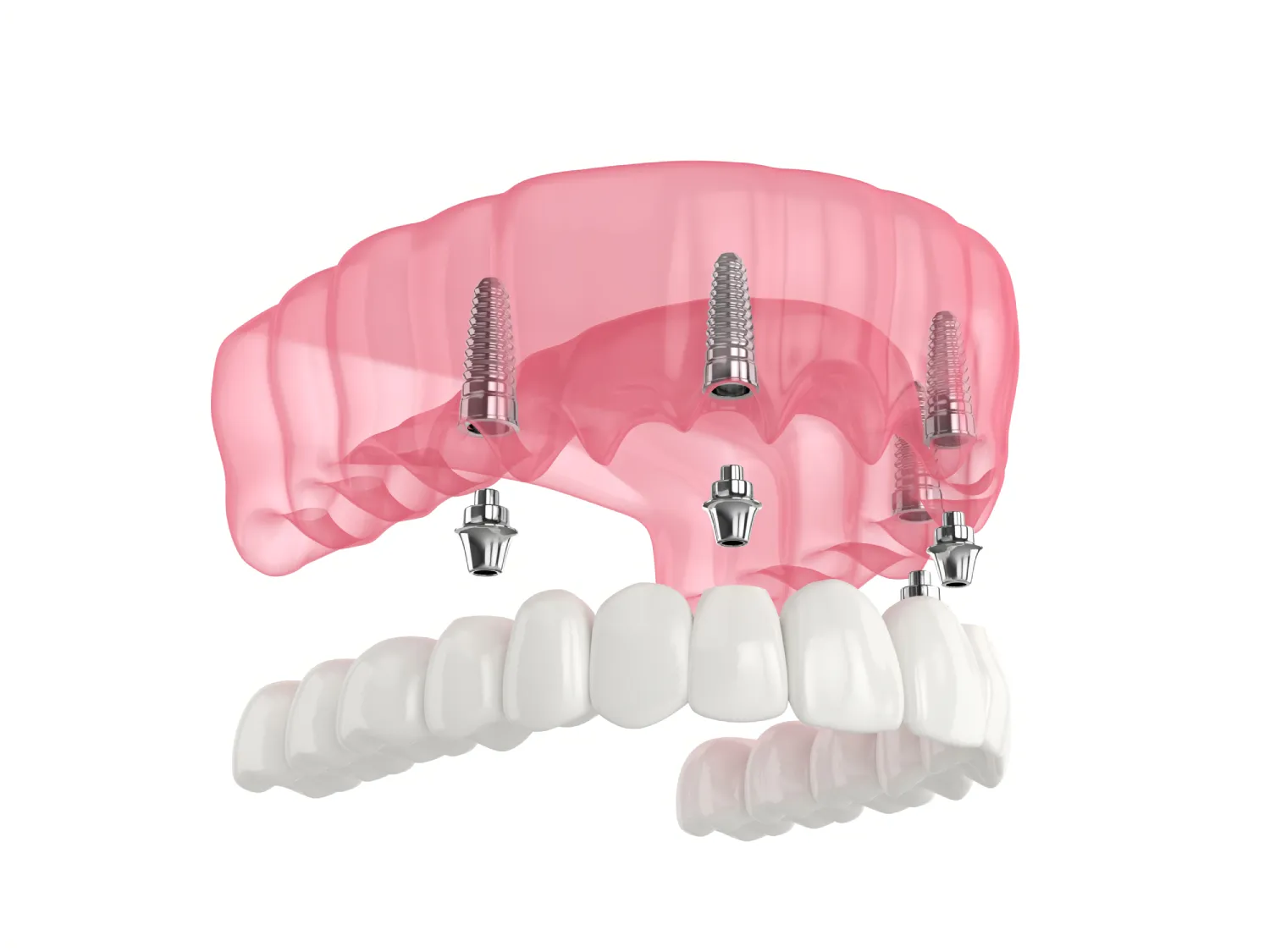 Full Arch Implants